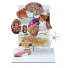 Effects of Type II Diabetes, 8 Parts